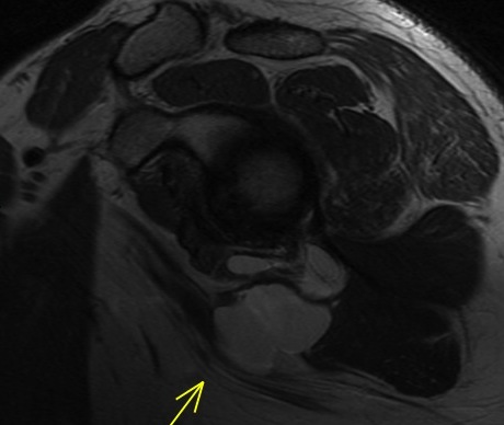 Figure 6 for case Axillary cyst and denervation